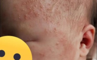 新生儿痤疮留坑怎么办