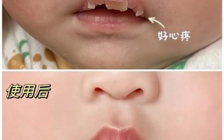 儿童嘴唇干是缺水还是生病了？日常护理要注意什么？
