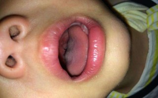 新生儿喉咙好像有东西，是正常现象还是需要紧急处理？