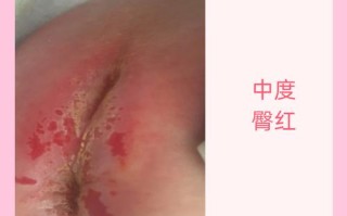 新生儿屁股眼出现湿疹，是什么原因导致的？应该如何正确处理和护理呢？