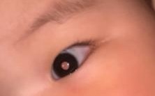 新生儿眼角发白是正常现象还是疾病信号？需警惕哪些眼部异常？