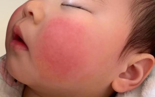 新生儿脸老是涨的通红