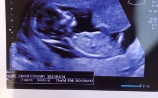 孕期13周NT检查是啥？