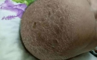 新生儿腋下白色分泌物是正常现象还是需要警惕的健康问题？