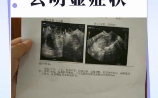 孕期盆腔炎有哪些典型症状？会对胎儿造成哪些影响？