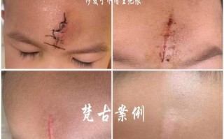 儿童烧伤疤痕修复有哪些科学方法？不同年龄段修复效果差异大吗？