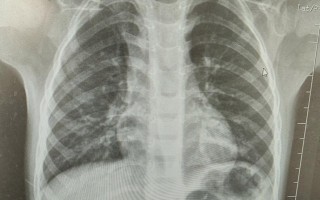 新生儿拍肺部CT影响有多大？