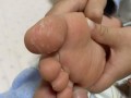 新生儿脚上脱皮是正常生理现象还是需要警惕的健康问题？