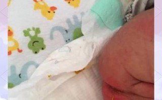 新生儿肛门上有个小洞是正常生理结构还是异常情况？需要就医处理吗？