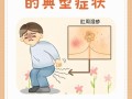孕期肛门瘙痒是激素变化还是疾病信号？如何缓解才安全？