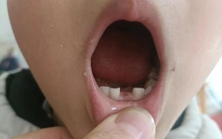 儿童梦见掉牙是身体信号还是心理暗示？背后隐藏哪些成长秘密？