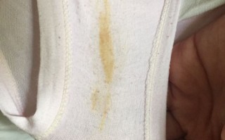 怀孕期间白带发黄又多，是正常现象还是感染信号？