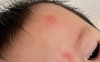 新生儿被蚊子咬起红点咋处理？