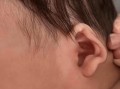 新生儿左耳没有外耳廓