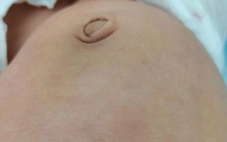 新生儿肚脐内凹陷，是何原因？