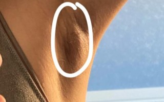 孕期腋下按压痛的肿块会是严重问题吗？需要立即就医检查吗？