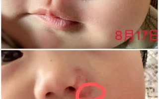 新生儿为何会长血管瘤？背后原因与家长该知道的真相是什么？