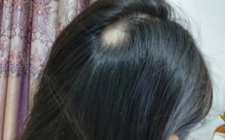 孕期为何会突然出现斑秃？是激素波动还是营养失衡在作祟？