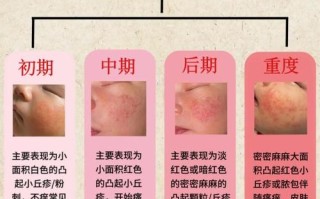 新生儿痤疮和婴儿痤疮是一回事吗？该如何区分护理？