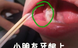 儿童牙龈长脓包该吃什么药？盲目用药会加重感染吗？