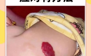 新生儿血管瘤早期症状有哪些？家长该如何识别和应对？