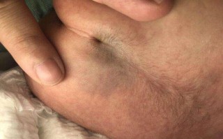 新生儿隐性脊柱裂有哪些容易被忽视的早期表现？