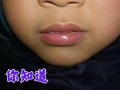 新生儿宝宝上嘴唇突出是正常发育还是异常信号？需警惕哪些潜在问题？