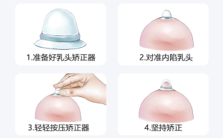 孕期乳头内陷不干预会影响哺乳吗？矫正方法安全吗？