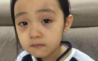 新生儿黑眼珠出现像头发丝一样的细丝，是正常生理现象还是眼部异常信号？