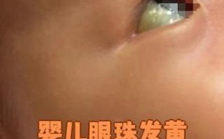 新生儿眼球不一样颜色