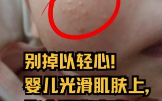 孕期挤痘痘会影响胎宝宝吗？