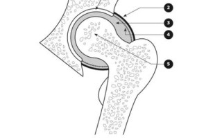 儿童髋关节滑膜炎有哪些典型症状？家长如何早期识别与应对？