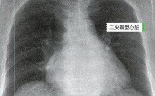 儿童肺动脉段突出究竟是什么原因导致的？