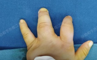 儿童手指畸形治疗，国内哪家医院在矫正技术与术后康复方面更权威？