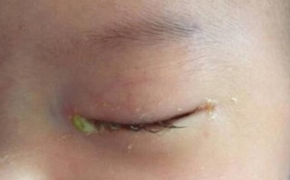 新生儿黄疸眼睛会发黄吗？这可能是哪些信号在警示？