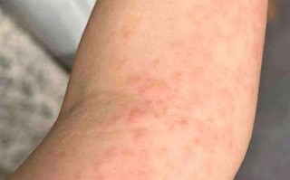 孕期手臂痒是皮肤问题还是激素变化？需要警惕哪些潜在风险？