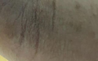 怀孕期间腋下变黑是什么原因？图片显示正常吗？需要担心吗？