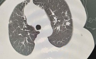 剖腹产新生儿肺部感染风险高，如何有效预防与科学护理？