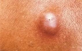 孕期外阴突然长硬疙瘩，是炎症还是肿瘤？需要紧急就医吗？