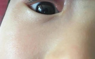 新生儿睫毛根部长痘痘是正常现象吗？需要处理吗？