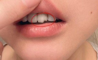 孕期烤瓷牙松动，会不会影响胎儿健康？该如何安全处理？