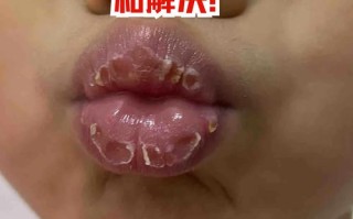 儿童嘴唇干裂是缺水、过敏还是疾病信号？家长该如何科学应对？