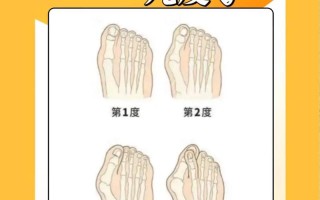 儿童拇指外翻治疗的最佳方法是什么？需要手术吗？