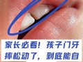 儿童门牙松动一直不掉怎么办？