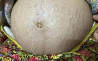 孕期肚毛增长是激素变化吗？