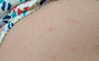 孕期肚子上起小红点还痒，是妊娠特有反应还是皮肤问题？