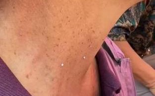 孕期脖上小肉粒是何原因？