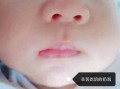 新生儿嘴上的白泡是正常现象吗？需要处理吗？附图片对比一下？