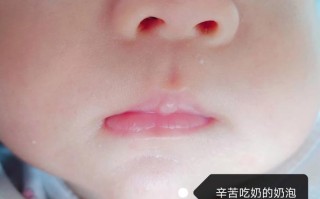 新生儿嘴上的白泡是正常现象吗？需要处理吗？附图片对比一下？