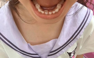 儿童自己在家拔牙如何才能做到真正不痛且安全？